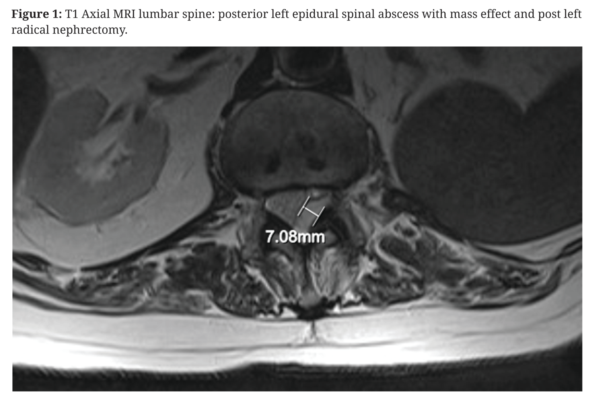 Spinal epidural abscesses – The BMAS Blog