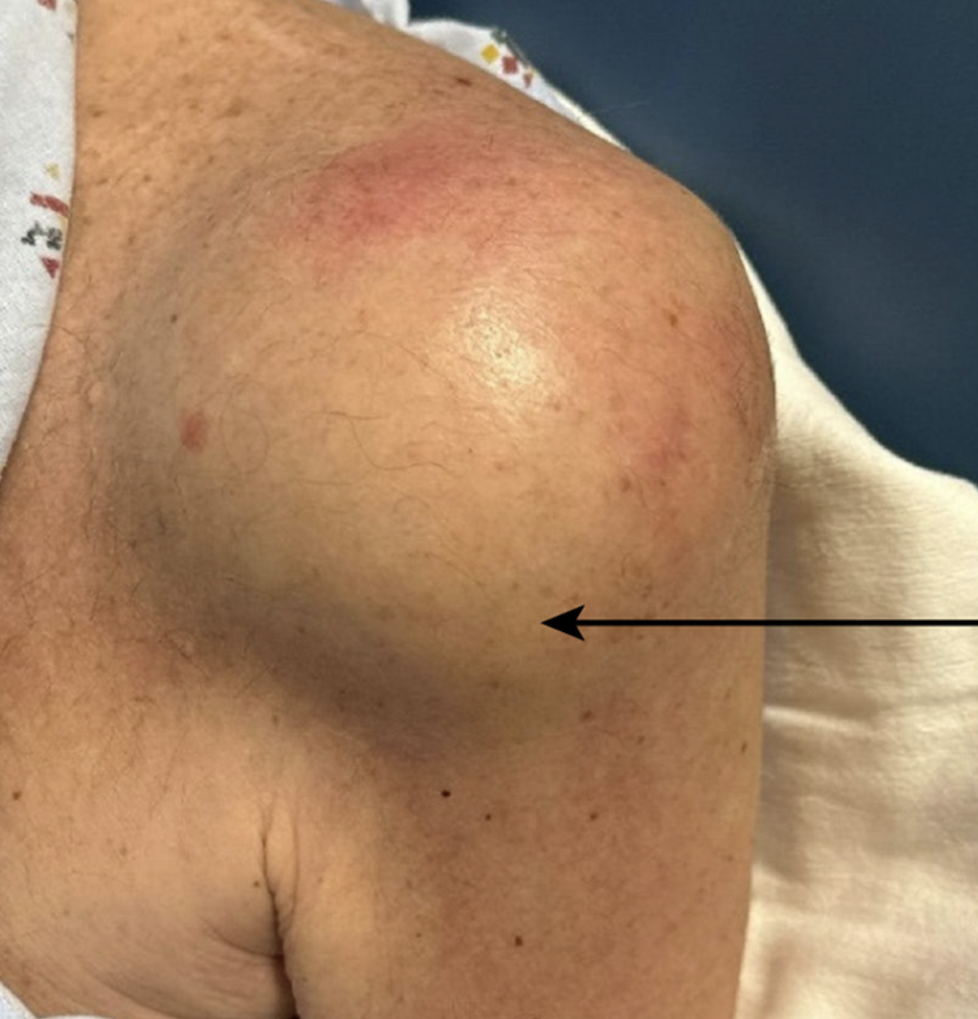 Septic arthritis during chemotherapy – The BMAS Blog